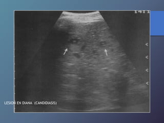 LESION EN DIANA (CANDIDIASIS)
 