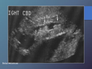 Bolas Micoticas
 