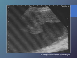 Ca hepatocelular con hemorragia
 