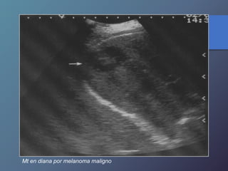 Mt en diana por melanoma maligno
 