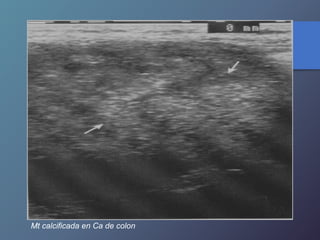 Mt calcificada en Ca de colon
 