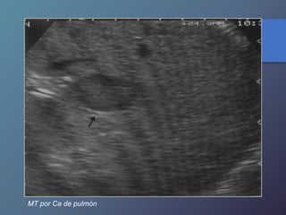 MT por Ca de pulmón
 