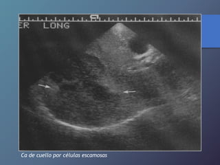 Ca de cuello por células escamosas
 