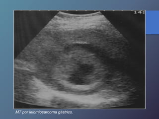 MT por leiomiosarcoma gástrico.
 