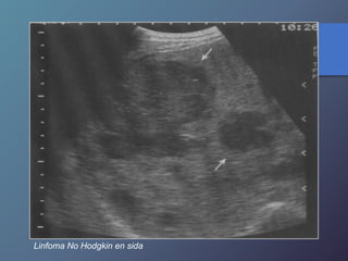 Linfoma No Hodgkin en sida
 