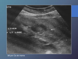 Mt por Ca de mama
 
