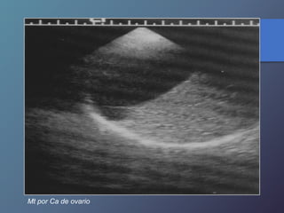 Mt por Ca de ovario
 