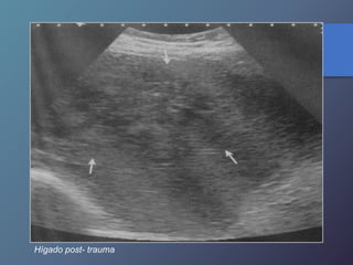 Hígado post- trauma
 