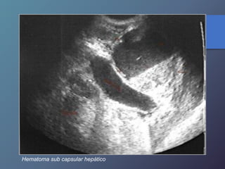 Hematoma sub capsular hepático
 