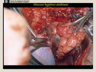 “Curso de Anatomía Humana:
 Carrera de Médico Cirujano”

                               Absceso hepático amibiano




                                                           45
 