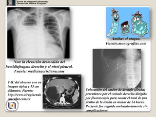 “Curso de Anatomía Humana:
       Carrera de Médico Cirujano”




                                                             Amibas al ataque.
                                                          Fuente:monografias.com



    Note la elevación desmedida del
hemidiafragma derecho y el nivel pleural.
    Fuente: medicinacristiana.com

 TAC del absceso con su
 imagen típica y 15 cm
 diámetro. Fuente:                          Colocación del catéter de drenaje (flecha)
 http://www.cirugiaendo                     percutàneo por el costado derecho dirigido
 vascular.com.ve                            por fluoroscopia para vaciar el total de pus
                                            dentro de la lesión en menos de 24 horas.
                                            Paciente fue seguido ambulatoriamente sin
                                                                                        46
                                            complicaciones
 