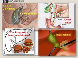 “Curso de Anatomía Humana:
      Carrera de Médico Cirujano”



Litiasis
Colelitiasis
                          Coledocolitiasis

                                                      Cólico
                                                      biliar


       Comida grasosa:
     factor condicionante                    Colecistectomía




                                                               50
 