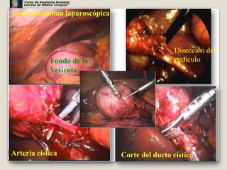 “Curso de Anatomía Humana:
    Carrera de Médico Cirujano”


Colecistectomía laparoscópica



                                                  Disección del
                   Fondo de la                    pedículo
                   Vesícula




Arteria cística                   Corte del ducto cístico     52
 