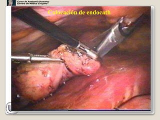 “Curso de Anatomía Humana:
 Carrera de Médico Cirujano”




                          Colocación de endocath




                                                   53
 