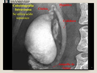 “Curso de Anatomía Humana:
 Carrera de Médico Cirujano”


    Colecistografía                      Hepático
     Intravenosa               Cístico
    Se utiliza acido
      iopanoico
                                           Colédoco




                                         Ampolla de
                                          Vatter      55
 