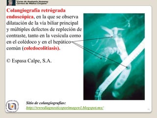 “Curso de Anatomía Humana:
     Carrera de Médico Cirujano”


Colangiografía retrógrada
endoscópica, en la que se observa
dilatación de la vía biliar principal
y múltiples defectos de repleción de
contraste, tanto en la vesícula como
en el colédoco y en el hepático
común (coledocolitiasis).

© Espasa Calpe, S.A.




            Sitio de colangiografías:
            http://wwwdiagnosticoporimagen1.blogspot.mx/   59
 
