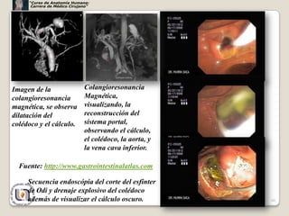 “Curso de Anatomía Humana:
      Carrera de Médico Cirujano”




Imagen de la                  Colangioresonancia
colangioresonancia            Magnética,
magnética, se observa         visualizando, la
dilatación del                reconstrucción del
colédoco y el cálculo.        sistema portal,
                              observando el cálculo,
                              el colédoco, la aorta, y
                              la vena cava inferior.

  Fuente: http://www.gastrointestinalatlas.com

     Secuencia endoscópia del corte del esfínter
     de Odi y drenaje explosivo del colédoco
     además de visualizar el cálculo oscuro.             60
 