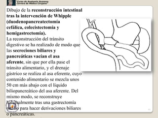 “Curso de Anatomía Humana:
      Carrera de Médico Cirujano”


Dibujo de la reconstrucción intestinal
tras la intervención de Whipple
(duodenopancreatectomía
cefálica, colecistectomía y
hemigastrectomía).
La reconstrucción del tránsito
digestivo se ha realizado de modo que
las secreciones biliares y
pancreáticas vacían el asa
aferente, sin que por ella pase el
tránsito alimentario, y el drenaje
gástrico se realiza al asa eferente, cuyo
contenido alimentario se mezcla unos
50 cm más abajo con el líquido
biliopancreático del asa aferente. Del
mismo modo, se reconstruye
habitualmente tras una gastrectomía
total o para hacer derivaciones biliares    61

o pancreáticas.
 