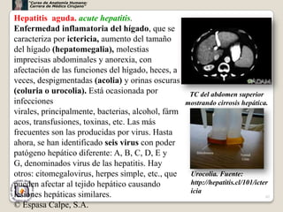 “Curso de Anatomía Humana:
     Carrera de Médico Cirujano”


Hepatitis aguda. acute hepatitis.
Enfermedad inflamatoria del hígado, que se
caracteriza por ictericia, aumento del tamaño
del hígado (hepatomegalia), molestias
imprecisas abdominales y anorexia, con
afectación de las funciones del hígado, heces, a
veces, despigmentadas (acolia) y orinas oscuras
(coluria o urocolia). Está ocasionada por          TC del abdomen superior
infecciones                                       mostrando cirrosis hepática.
virales, principalmente, bacterias, alcohol, fárm
acos, transfusiones, toxinas, etc. Las más
frecuentes son las producidas por virus. Hasta
ahora, se han identificado seis virus con poder
patógeno hepático diferente: A, B, C, D, E y
G, denominados virus de las hepatitis. Hay
otros: citomegalovirus, herpes simple, etc., que   Urocolia. Fuente:
pueden afectar al tejido hepático causando         http://hepatitis.cl/101/icter
                                                   icia
lesiones hepáticas similares.                                                  62

© Espasa Calpe, S.A.
 