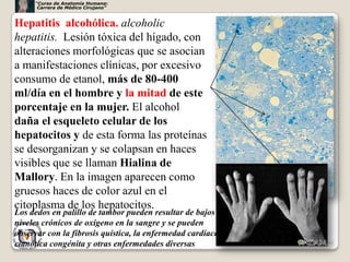 “Curso de Anatomía Humana:
      Carrera de Médico Cirujano”


Hepatitis alcohólica. alcoholic
hepatitis. Lesión tóxica del hígado, con
alteraciones morfológicas que se asocian
a manifestaciones clínicas, por excesivo
consumo de etanol, más de 80-400
ml/día en el hombre y la mitad de este
porcentaje en la mujer. El alcohol
daña el esqueleto celular de los
hepatocitos y de esta forma las proteínas
se desorganizan y se colapsan en haces
visibles que se llaman Hialina de
Mallory. En la imagen aparecen como
gruesos haces de color azul en el
citoplasma de los hepatocitos.
Los dedos en palillo de tambor pueden resultar de bajos
niveles crónicos de oxígeno en la sangre y se pueden
observar con la fibrosis quística, la enfermedad cardíaca
cianótica congénita y otras enfermedades diversas           63
 