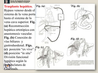 “Curso de Anatomía Humana:
     Carrera de Médico Cirujano”


Trasplante hepático. Fig. (a)      Fig. (b)
Bypass venoso desde el
sistema de la vena porta
hasta el sistema de la
vena cava superior. Fig.
(a) Reconstrucción
hepática ortotópica con
anastomosis vascular.
Fig. (b) Conexión de               Fig. (d)
vías biliares y
gastroduodenal. Figs. Fig. (c)
(c) posición “ex vivo” y
(d) posición “in situ”
División funcional
hepática según la
nomenclatura de
                                              68
Courinads.
 