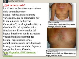 “Curso de Anatomía Humana:
     Carrera de Médico Cirujano”



¿Qué es la cirrosis?
La cirrosis es la consecuencia de un
daño acumulado en el
hígado, habitualmente durante
varios años, que se caracteriza por
la acumulación de fibrosis                 Ginecomastia.
(“cicatrices”) en el tejido hepático y     Fuente:http://galeria.sld.cu/main.
disminución del tejido hepático            php?g2_itemId=26485

funcionante. Estos cambios del
hígado interfieren con la estructura
y funcionamiento normal del
hígado, ocasionando serias
complicaciones en la circulación de
la sangre a través de dicho órgano y
en sus funciones. Fuente:
                                         Telangiectasia.
http://hepatitis.cl/617/cirrosis-        Fuente:http://galeria.sld.cu/main.ph
                                                                            69
hepatica                                 p?g2_itemId=26485
 