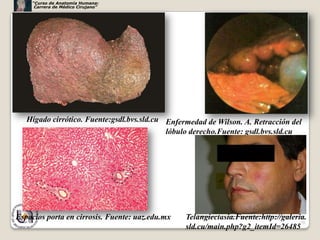 “Curso de Anatomía Humana:
     Carrera de Médico Cirujano”




   Hígado cirrótico. Fuente:gsdl.bvs.sld.cu Enfermedad de Wilson. A. Retracción del
                                            lóbulo derecho.Fuente: gsdl.bvs.sld.cu




Espacios porta en cirrosis. Fuente: uaz.edu.mx   Telangiectasia.Fuente:http://galeria.
                                                                                    70
                                                 sld.cu/main.php?g2_itemId=26485
 