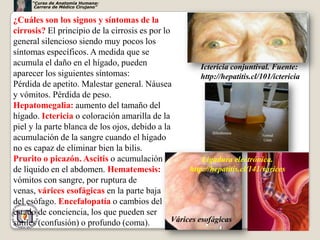 “Curso de Anatomía Humana:
       Carrera de Médico Cirujano”


¿Cuáles son los signos y síntomas de la
cirrosis? El principio de la cirrosis es por lo
general silencioso siendo muy pocos los
síntomas específicos. A medida que se
acumula el daño en el hígado, pueden                     Ictericia conjuntival. Fuente:
aparecer los siguientes síntomas:                        http://hepatitis.cl/101/ictericia
Pérdida de apetito. Malestar general. Náusea
y vómitos. Pérdida de peso.
Hepatomegalia: aumento del tamaño del
hígado. Ictericia o coloración amarilla de la
piel y la parte blanca de los ojos, debido a la
acumulación de la sangre cuando el hígado
no es capaz de eliminar bien la bilis.
Prurito o picazón. Ascitis o acumulación                 Ligadura electrónica.
de líquido en el abdomen. Hematemesis:               http://hepatitis.cl/141/varices
vómitos con sangre, por ruptura de
venas, várices esofágicas en la parte baja
del esófago. Encefalopatía o cambios del
estado de conciencia, los que pueden ser
sutiles (confusión) o profundo (coma).          Várices esofágicas                         72
 