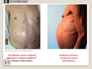 “Curso de Anatomía Humana:
   Carrera de Médico Cirujano”




 Circulación venosa colateral    Ascitis por cirrosis y
abdominal “medusa umbilical”.    circulación venosa
    Fuente: scielo.isciii.es        anterolateral.
                                                          74
 
