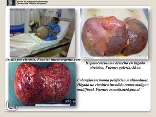 “Curso de Anatomía Humana:
       Carrera de Médico Cirujano”




Ascitis por cirrosis. Fuente: nuestra-gente.com
                                                  Hepatocarcinoma derecho en hígado
                                                    cirrótico. Fuente: galeria.sld.cu


                                            Colangiocarcinoma periférico multinodular.
                                            Hígado no cirrótico invadido tumor maligno
                                            multifocal. Fuente: escuela.med.puc.cl



                                                                                        75
 