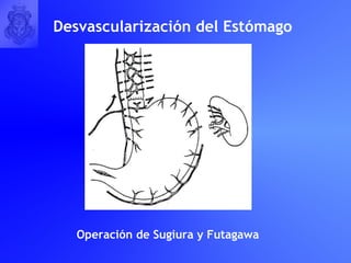 Desvascularización del Estómago Operación de Sugiura y Futagawa 