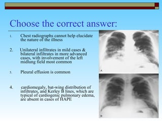 Choose the correct answer: Chest radiographs cannot help elucidate the nature of the illness 2.  Unilateral infiltrates in mild cases & bilateral infiltrates in more advanced cases, with involvement of the left midlung field most common  Pleural effusion is common 4.  cardiomegaly, bat-wing distribution of infiltrates, and Kerley B lines, which are typical of cardiogenic pulmonary edema, are absent in cases of HAPE  