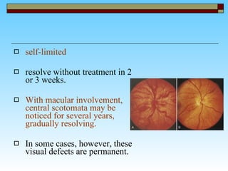 self-limited   resolve without treatment in 2 or 3 weeks. With macular involvement, central scotomata may be noticed for several years, gradually resolving. In some cases, however, these visual defects are permanent.  