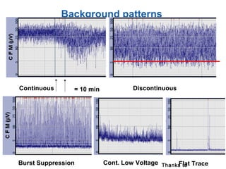 Continuous
Burst Suppression
Discontinuous
Cont. Low Voltage Flat Trace
= 10 min
Background patterns
Thanks to
 