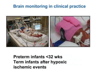 non invasive monitoring
Preterm infants <32 wks for 72 h
Neonates after perinatal asphyxia
Brain monitoring in clinical practice
Preterm infants <32 wks
Term infants after hypoxic
ischemic events
 