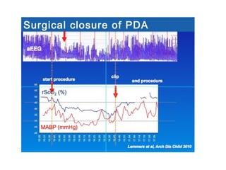 Surgical closure of PDA
 