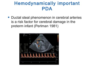 • Ductal steal phenomenon in cerebral arteries
is a risk factor for cerebral damage in the
preterm infant (Perlman 1981)
Hemodynamically important
PDA
 
