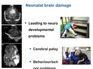 • Leading to neuro
developmental
problems
• Cerebral palsy
• Behaviour/sch
Neonatal brain damage
 