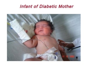 Infant of Diabetic Mother
 
