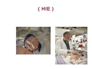 ( HIE )
 
