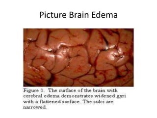 Picture Brain Edema
 