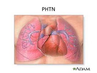 PHTN
 