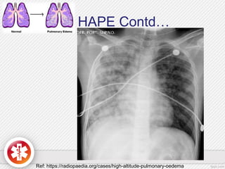 HAPE Contd…
Ref: https://radiopaedia.org/cases/high-altitude-pulmonary-oedema
 