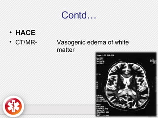 Contd…
• HACE
• CT/MR- Vasogenic edema of white
matter
 