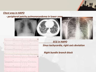Chest xray in HAPO
- peripheral patchy pulmonaryedema in lower zone
ECG in HAPO
Sinus tachycardia, right axis deviation
Right bundle branch block
 