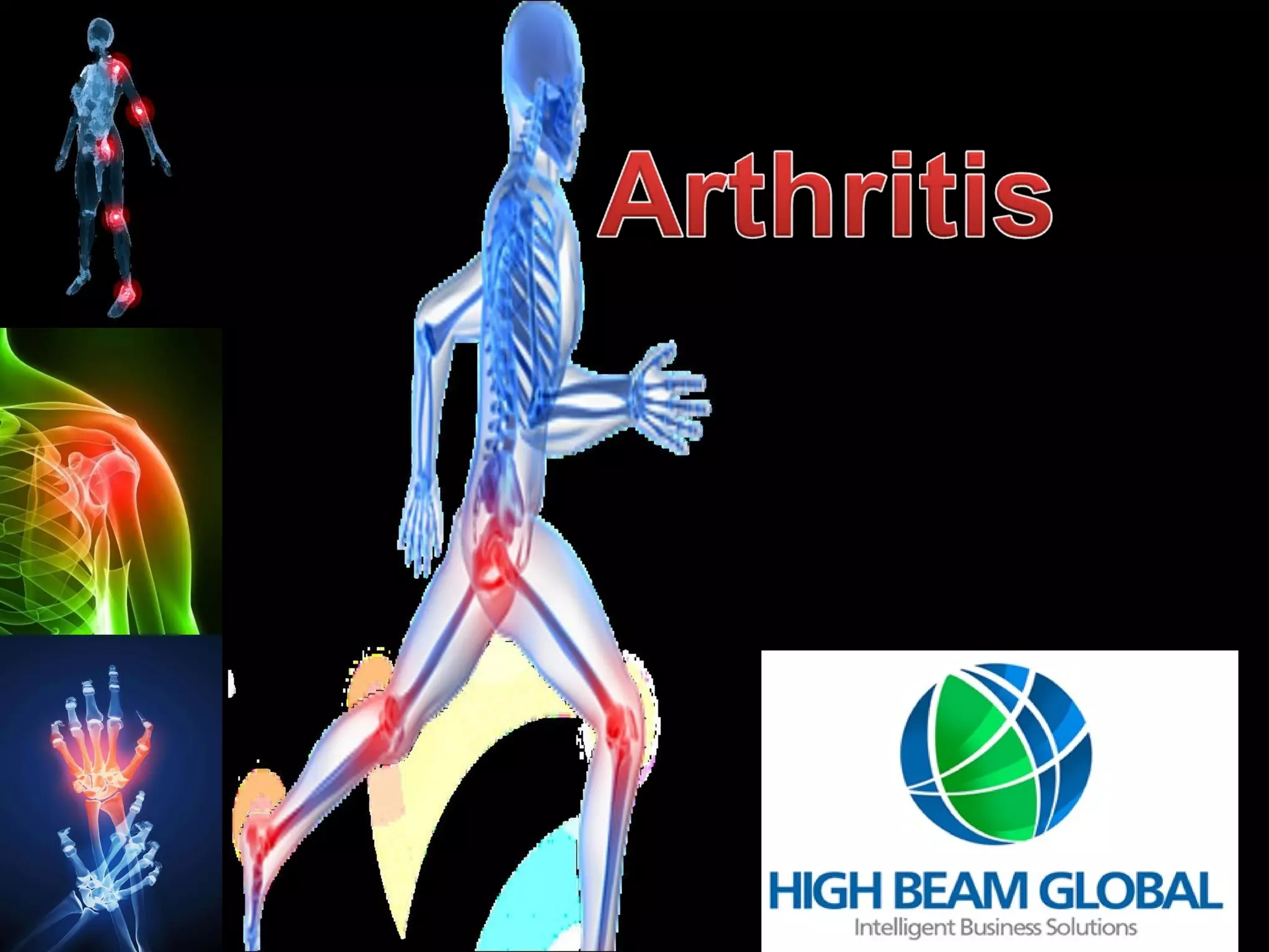 Arthritis PPT