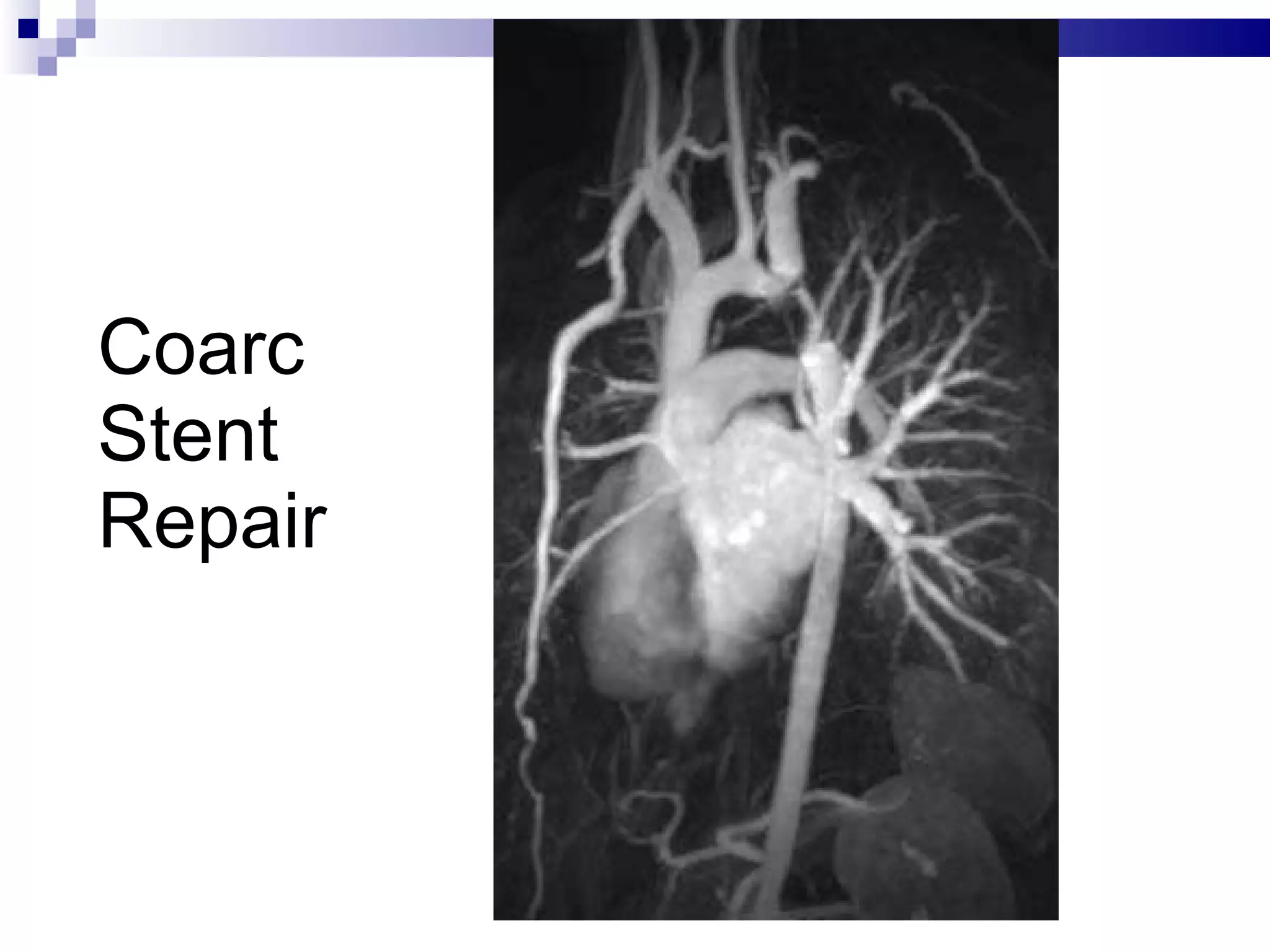 Coarc Stent Repair 