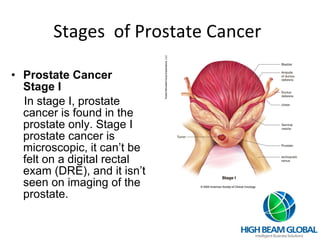 Stages  of Prostate Cancer Prostate Cancer Stage I In stage I, prostate cancer is found in the prostate only. Stage I prostate cancer is microscopic, it can’t be felt on a digital rectal exam (DRE), and it isn’t seen on imaging of the prostate. 