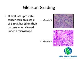 Gleason Grading It evaluates prostate cancer cells on a scale of 1 to 5, based on their pattern when viewed under a microscope. Grade 3 Grade 5 