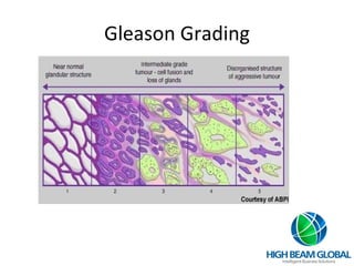 Gleason Grading 